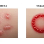 eczema or ringworm